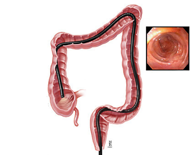 Nội soi đại - trực tràng chẩn đoán